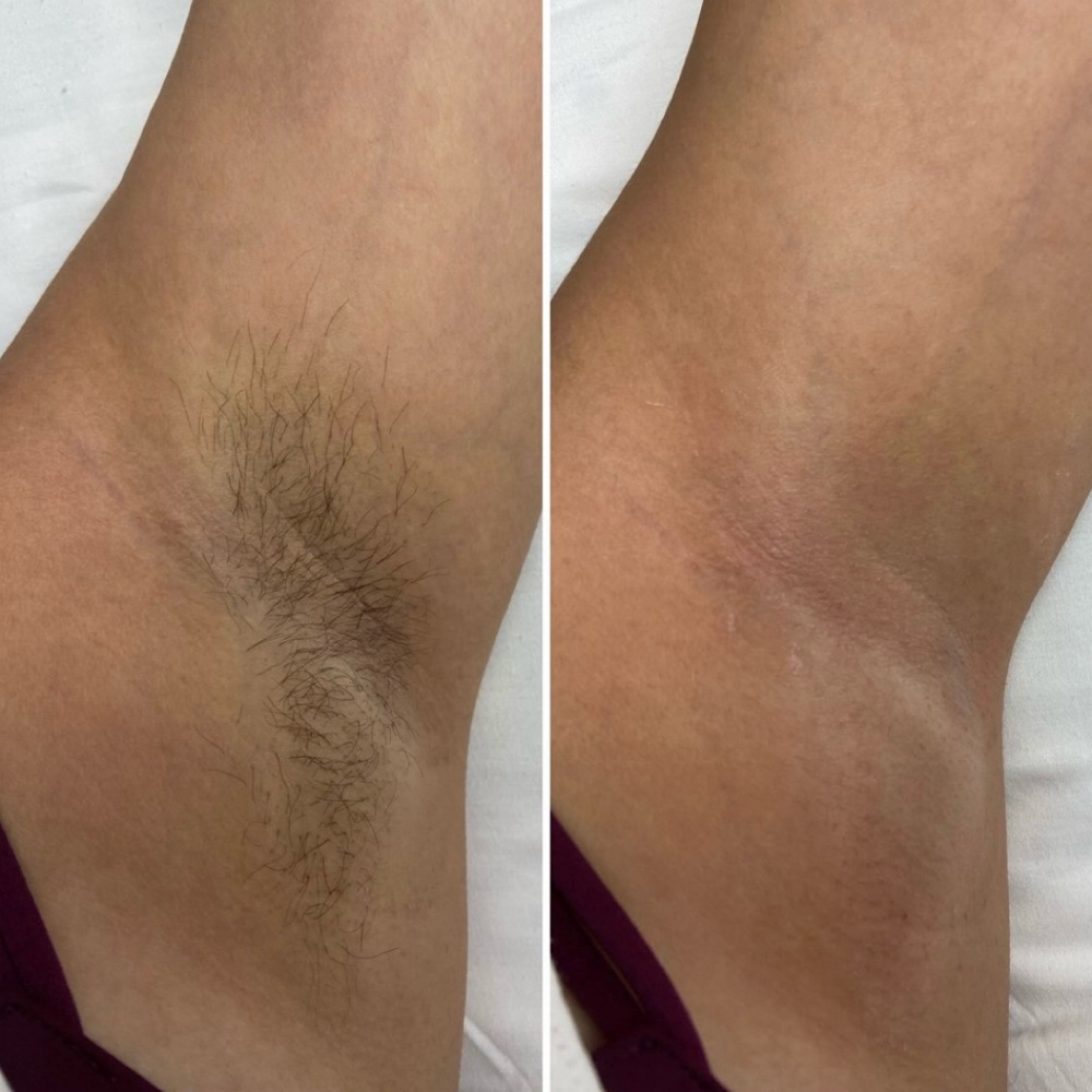 Underarms Wax at Glow Beauty Lounge in New Concord, OH