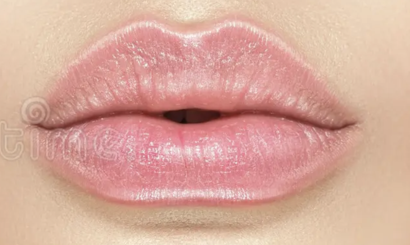 Dermal Filler Lips