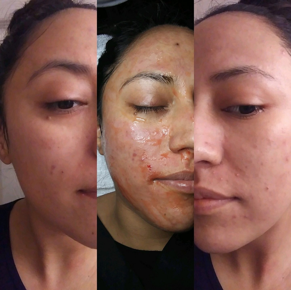 Microneedling + PRP