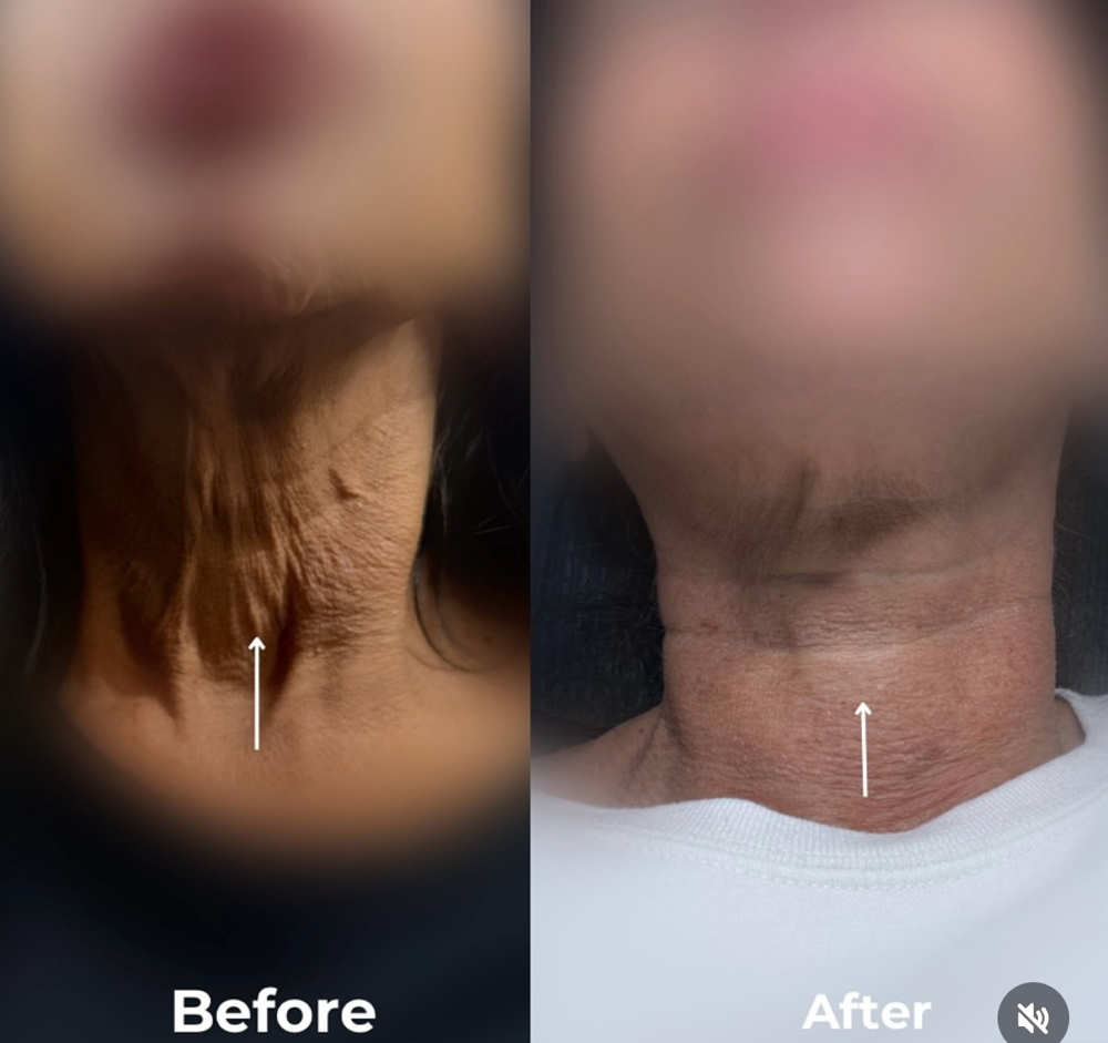 Tox - Neck Bands (Platysmal)