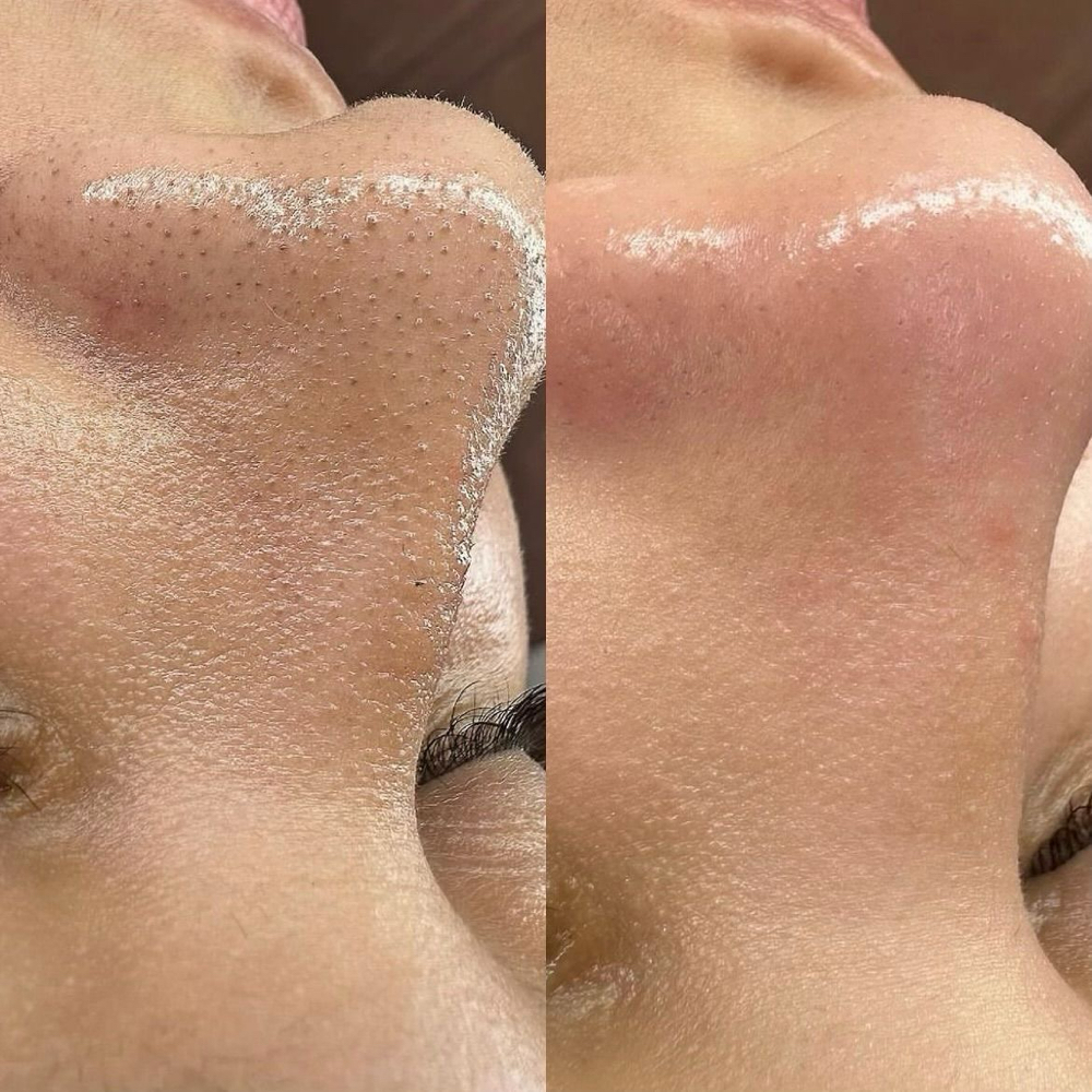 Extractions