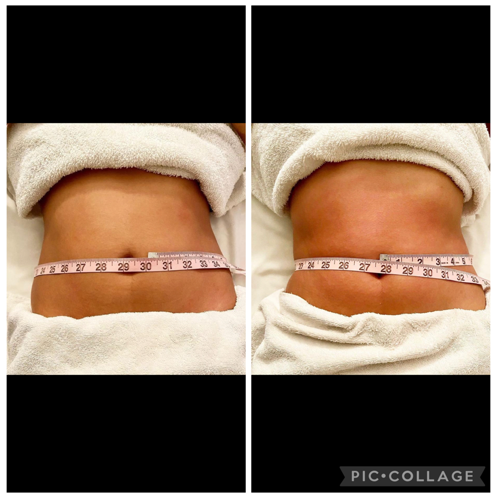 Special - Abs (cryoskin)