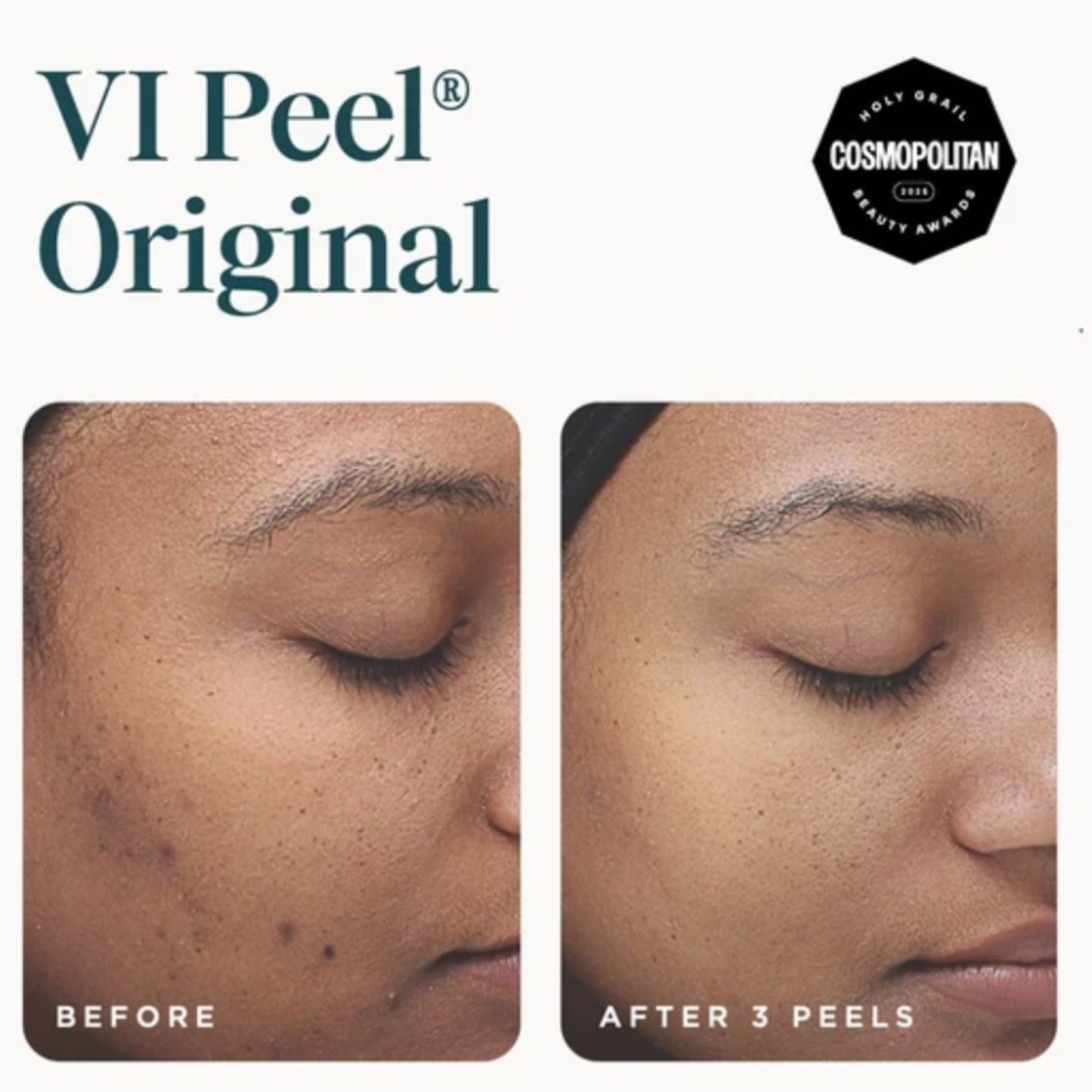 VI Peel at A. Shanel Aesthetics in Houston, TX