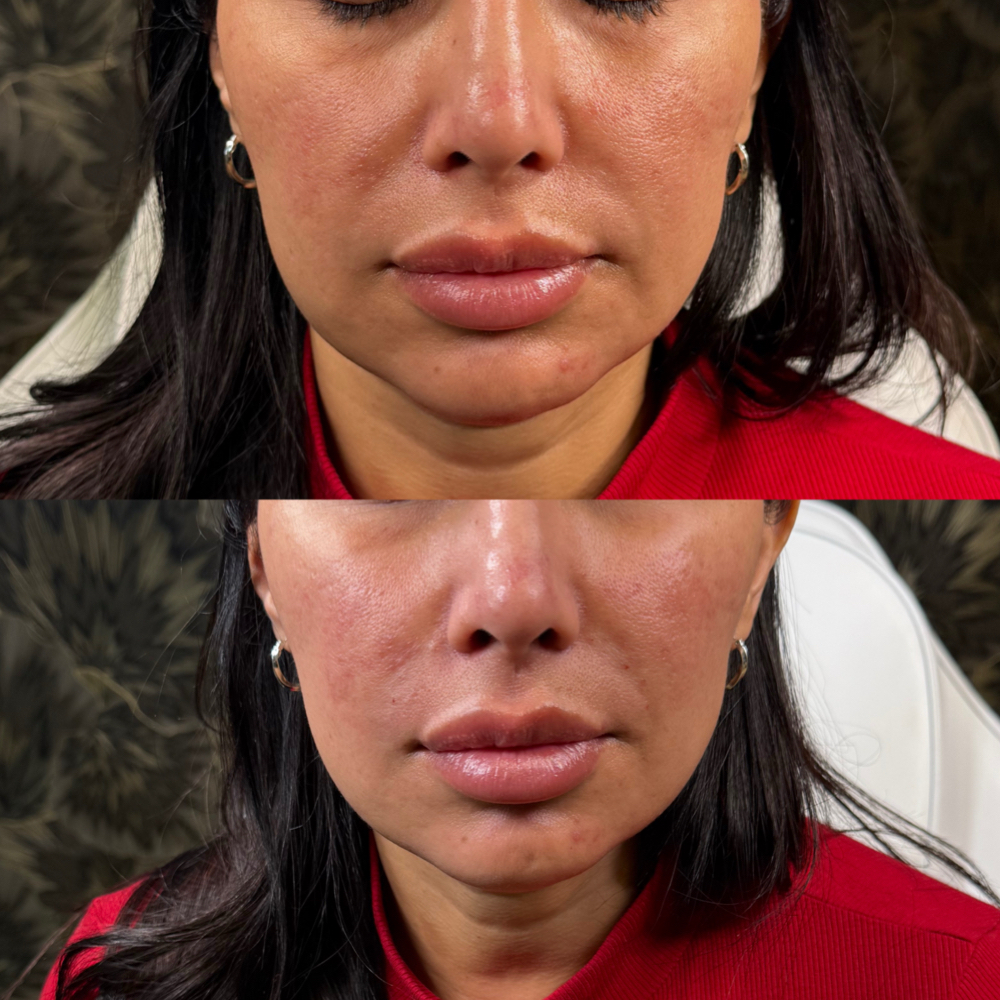 Nasolabial Folds (Smile Lines )