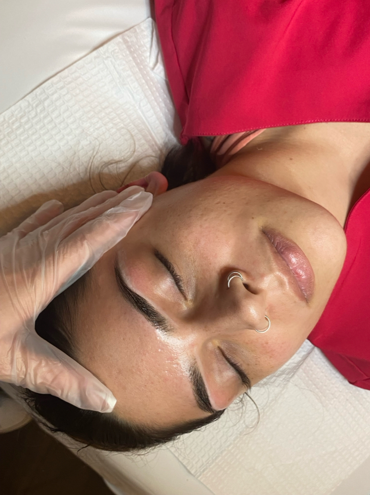 Acne Facial