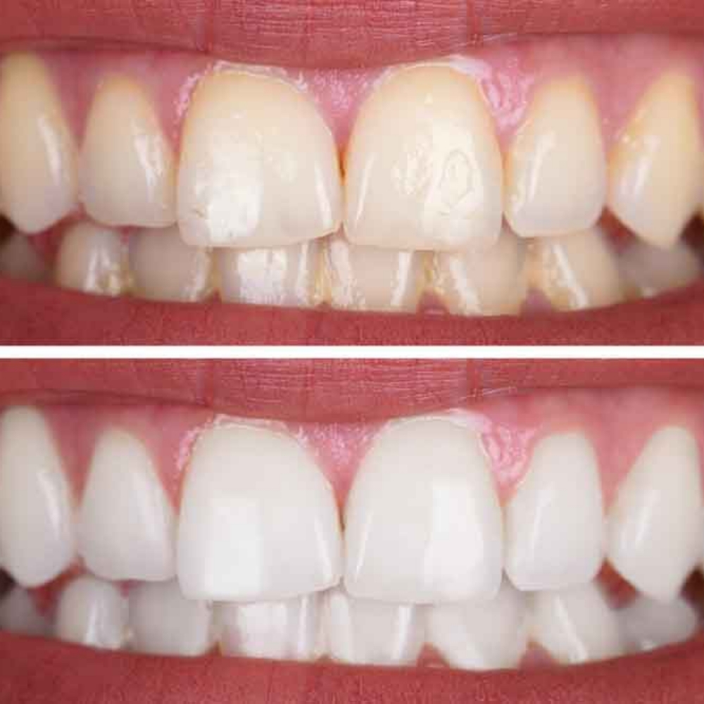 Professional Teeth Whitening 2 Sess at EVERWELL LUXE in Kissimmee, FL