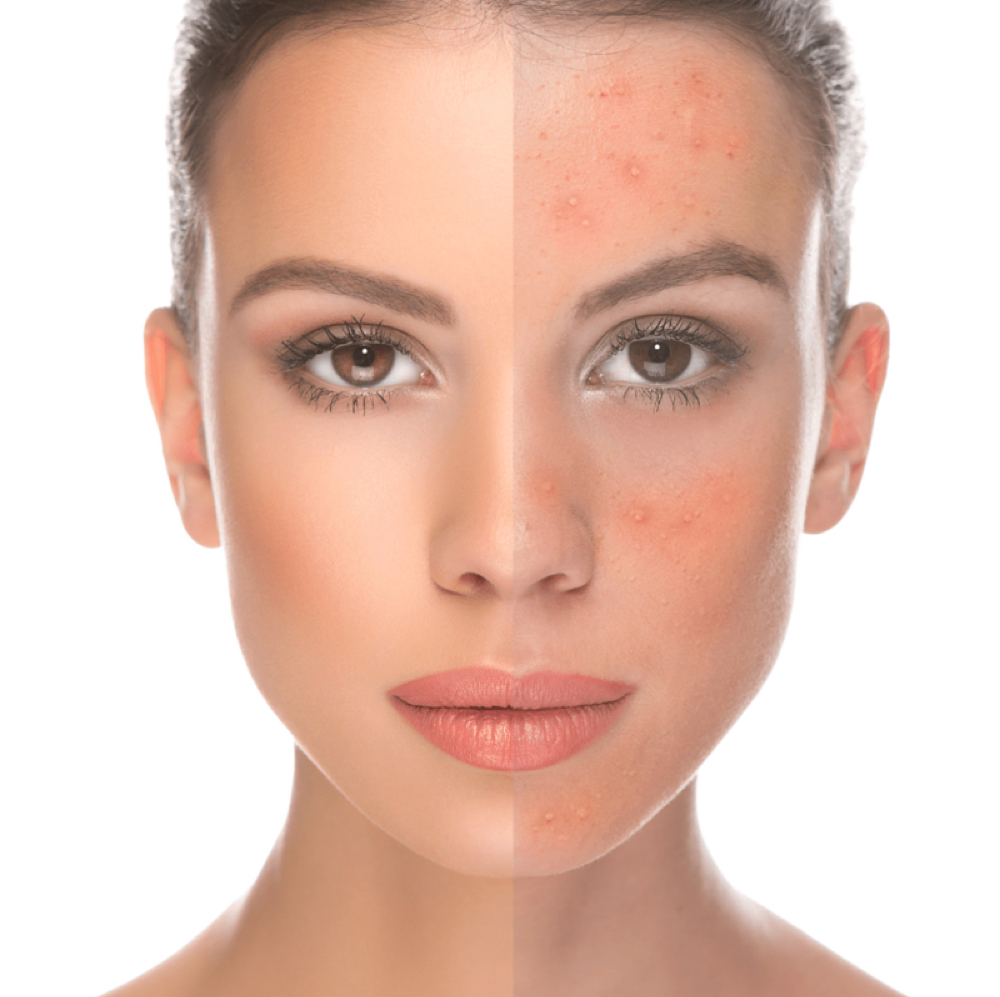 Acne Laser (NY) at Holistic Beauty in View On Website, NY