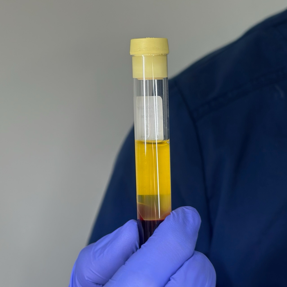 Plasma rico en plaquetas (PRP)