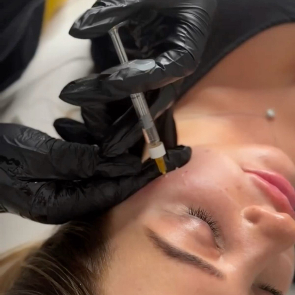 Facial Balancing 7 ML at Elevé Esthetics in Chicago, IL