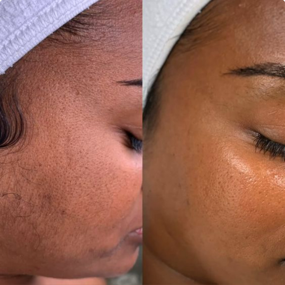 The Bare Face Facial