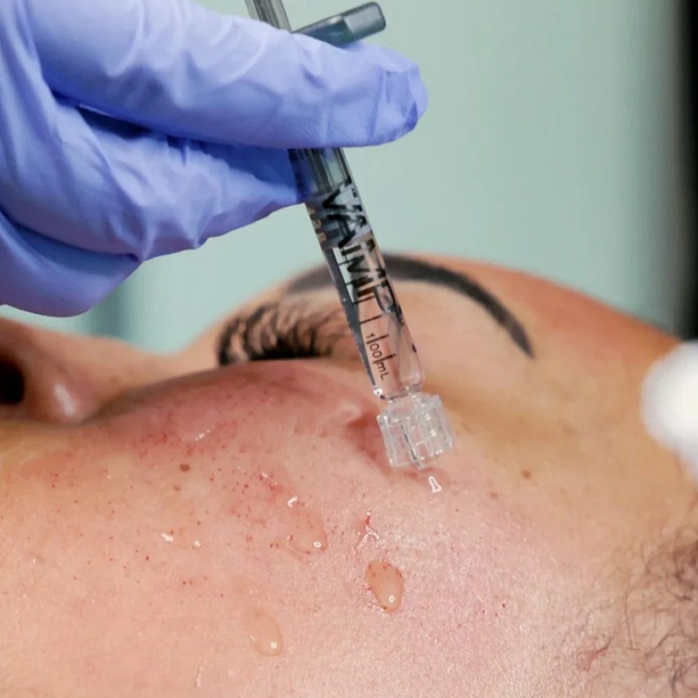 Microneedling + VAMP at Native Beauty in Garden City, MI
