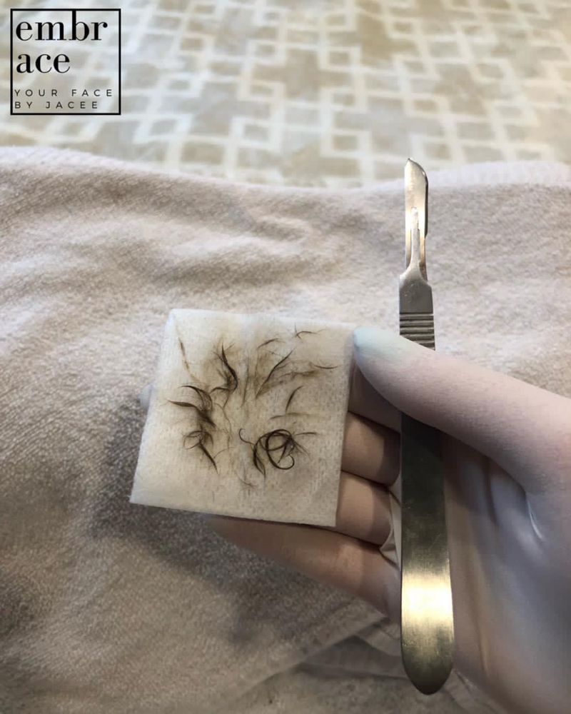 Dermaplane Facial