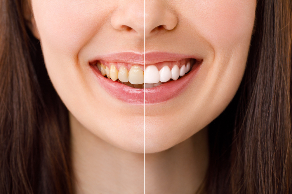 Teeth whitening