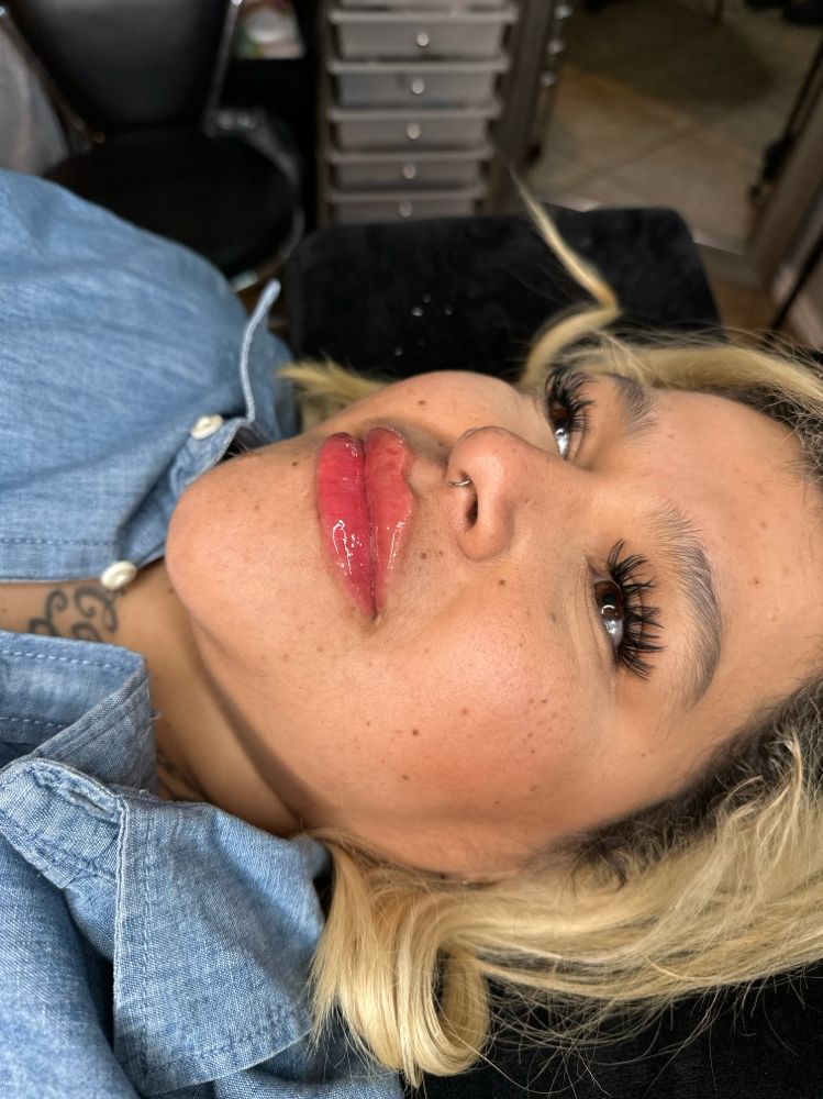 Lip filler 1mL