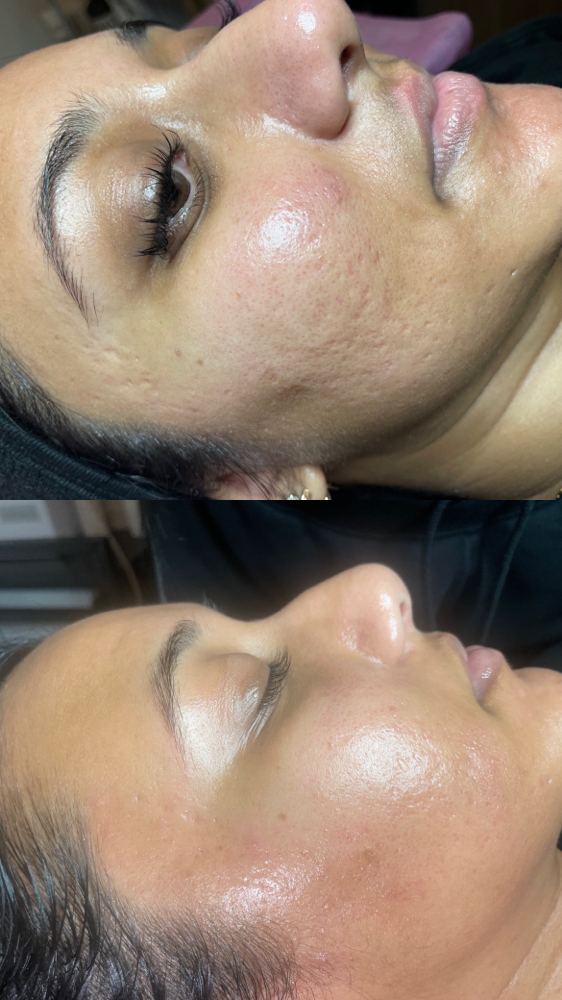 Acne Scar Transformation Package