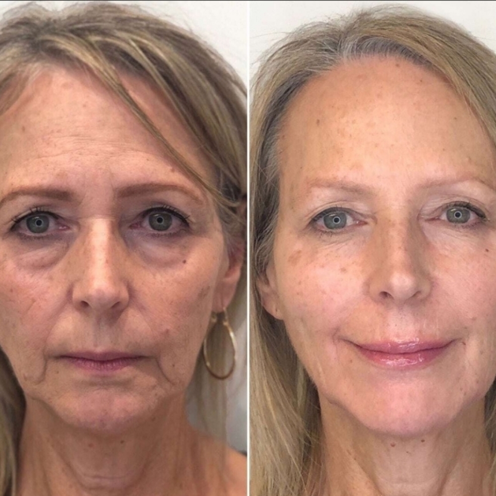 Anti-aging Facial Treatment