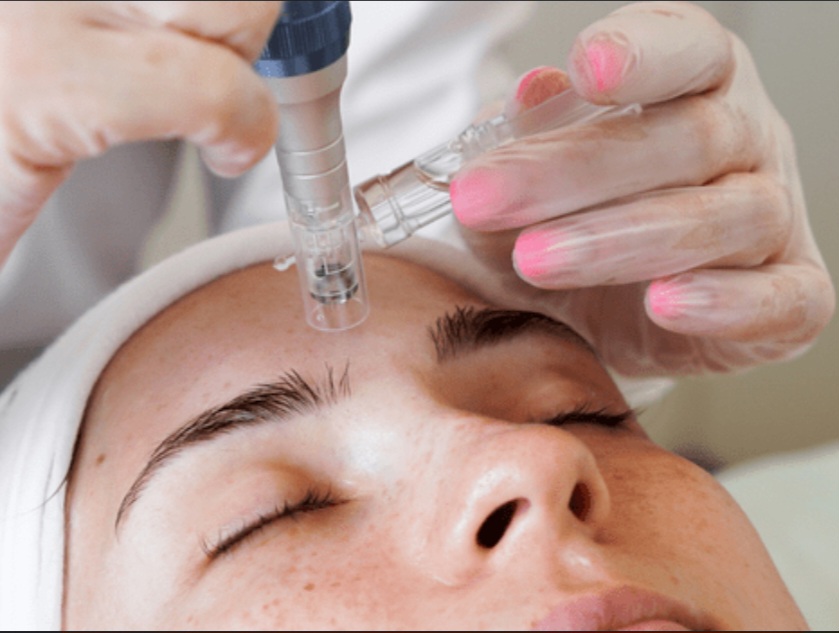 Microneedling W/O p.r.p.