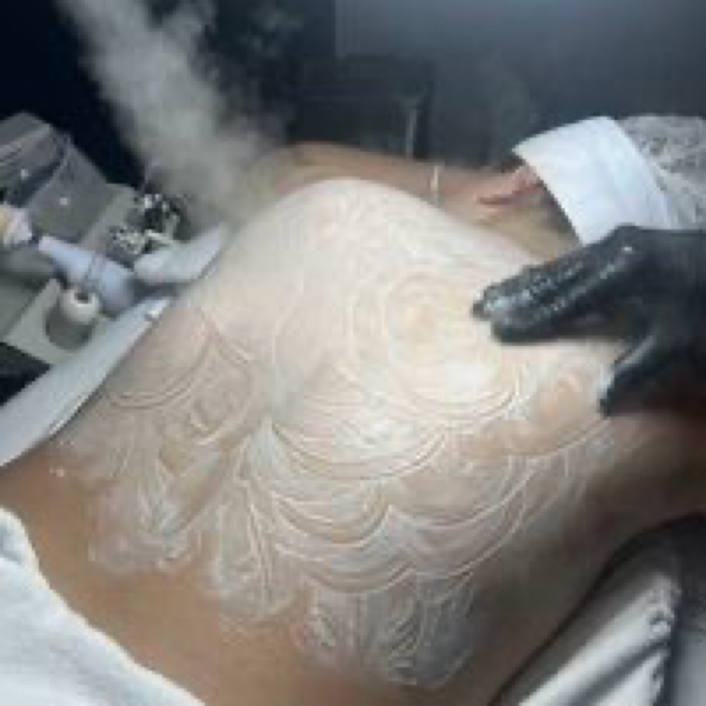 Back Facial at Sol Skin Esthetics in Fort Worth, TX