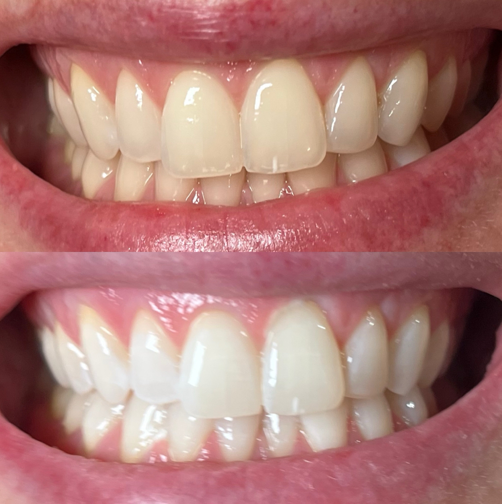 1-6 Month Touch-up Whitening at Bright White Co. in Crosslake, MN
