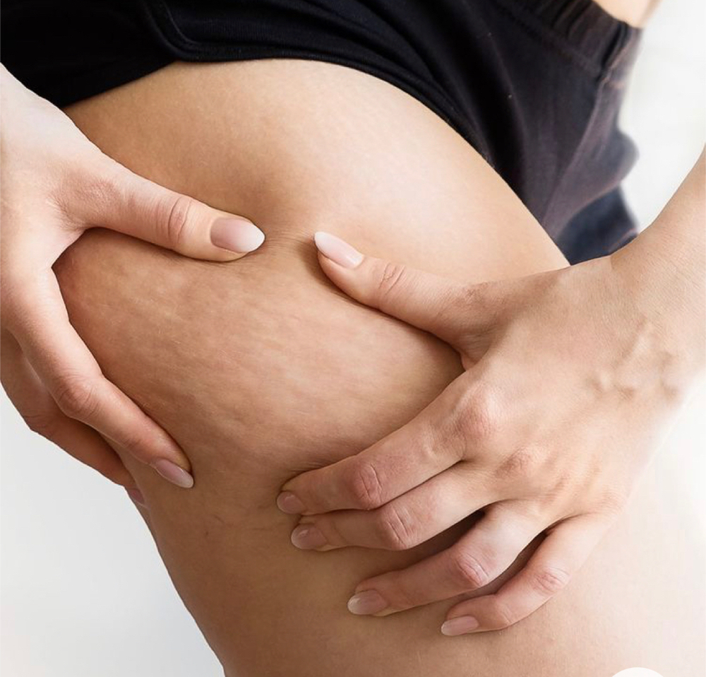 Cellulite Treatment