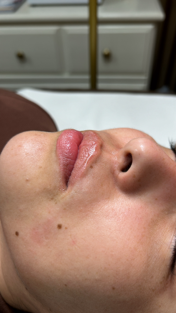 UPPER LIP