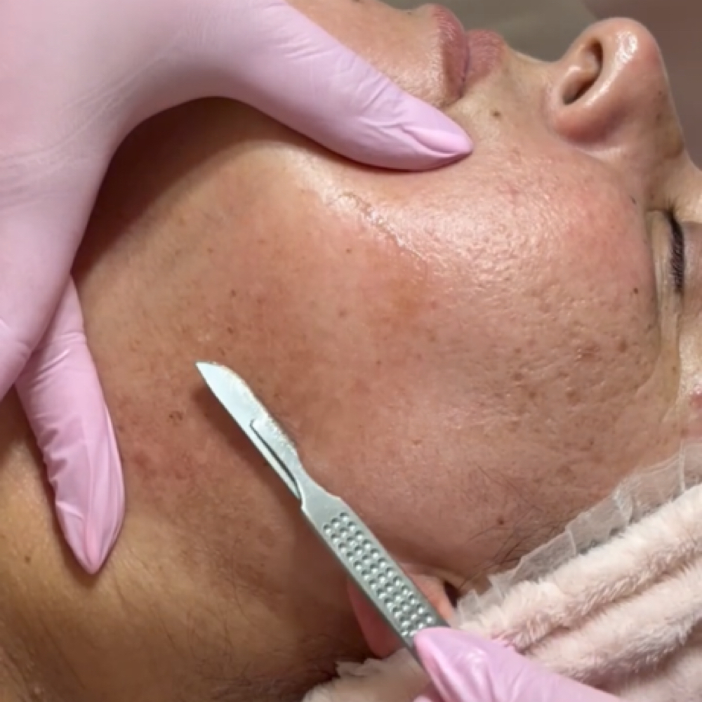 Dermaplane Facial Treatment at Cherry Bloom Beauty in Glendale, AZ