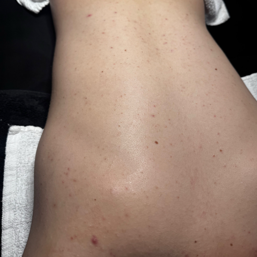 Back Treatment at Esthetics By Cheynne in Massapequa, NY