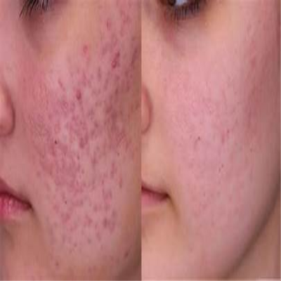 Post-Acne Scar at Sculpting Beauty by Pam LLC in Atascocita, TX