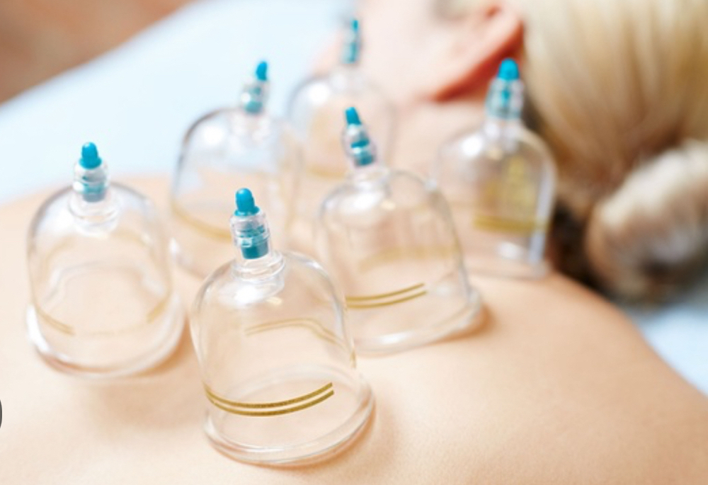 Cupping