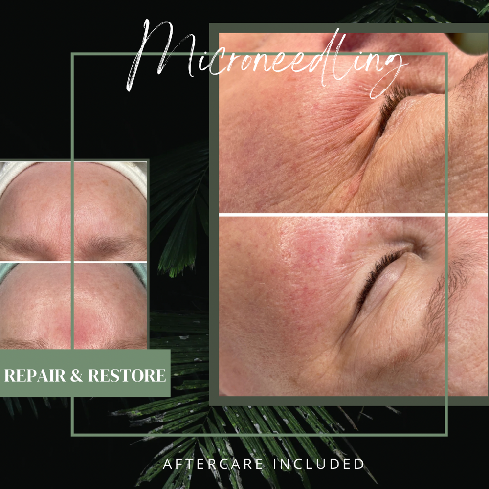 MICRONEEDLING (Aftercare Included)