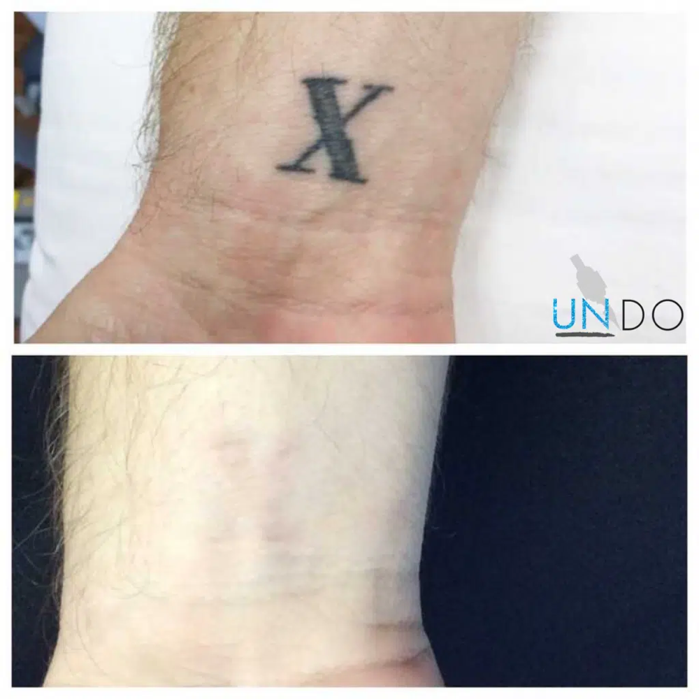 Non Laser Tattoo Removal