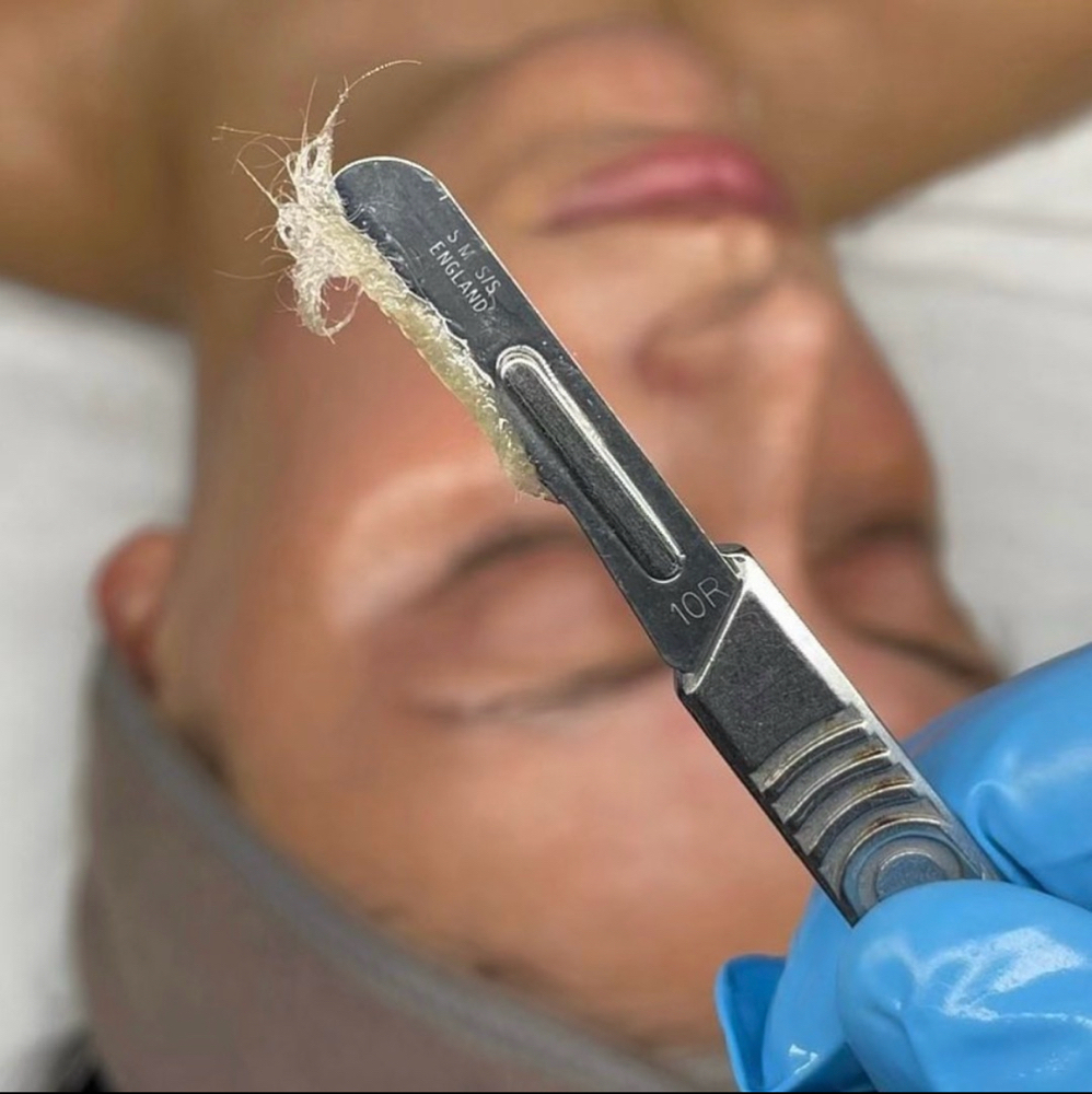 Add On - Dermaplaning