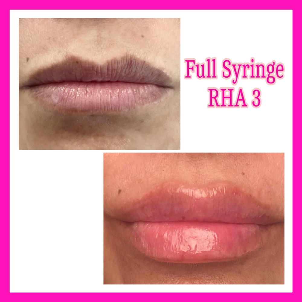 Full Lip Fill