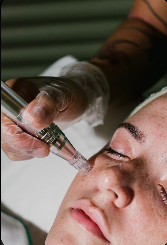 Stem Cell Facial With Nano-Needling