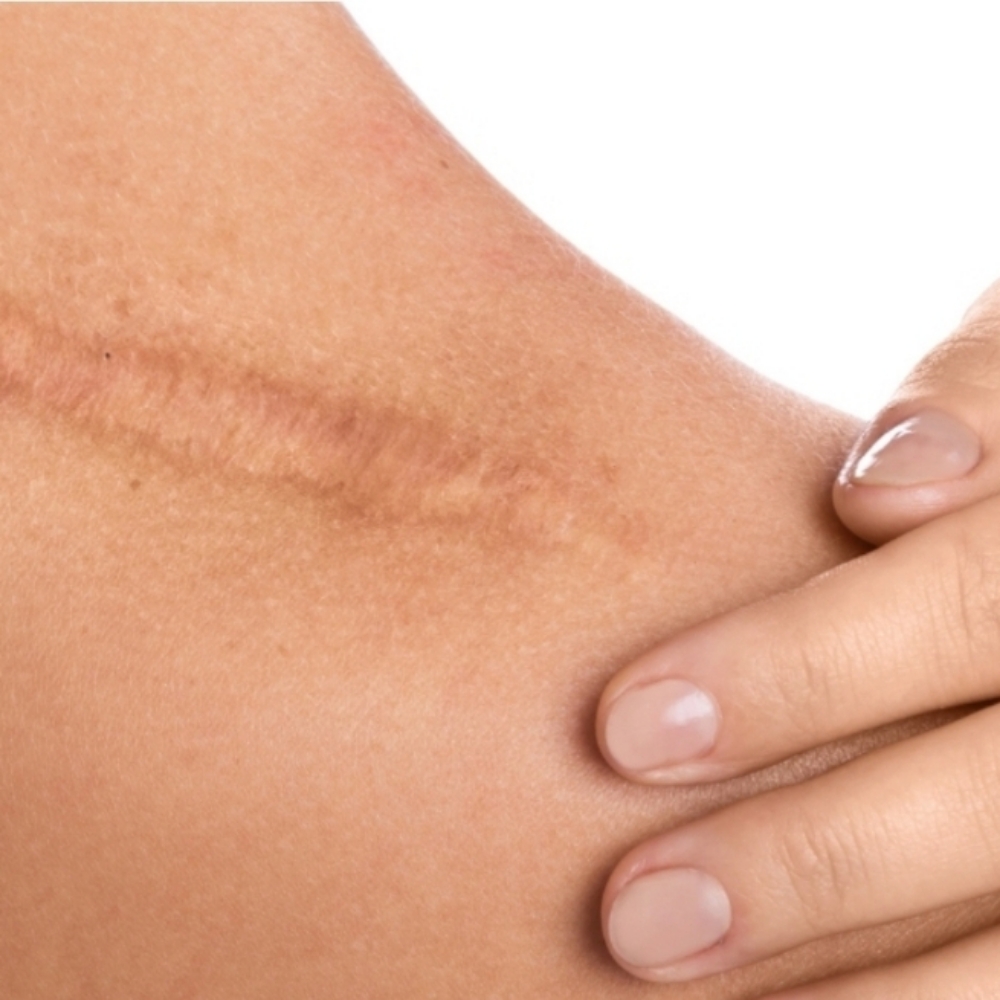 Scar Revision Inkless Or Camouflage at Pamper Me Ink  Paramedical Tattooing in Tucson, AZ