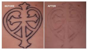 Tattoo Removal / Large