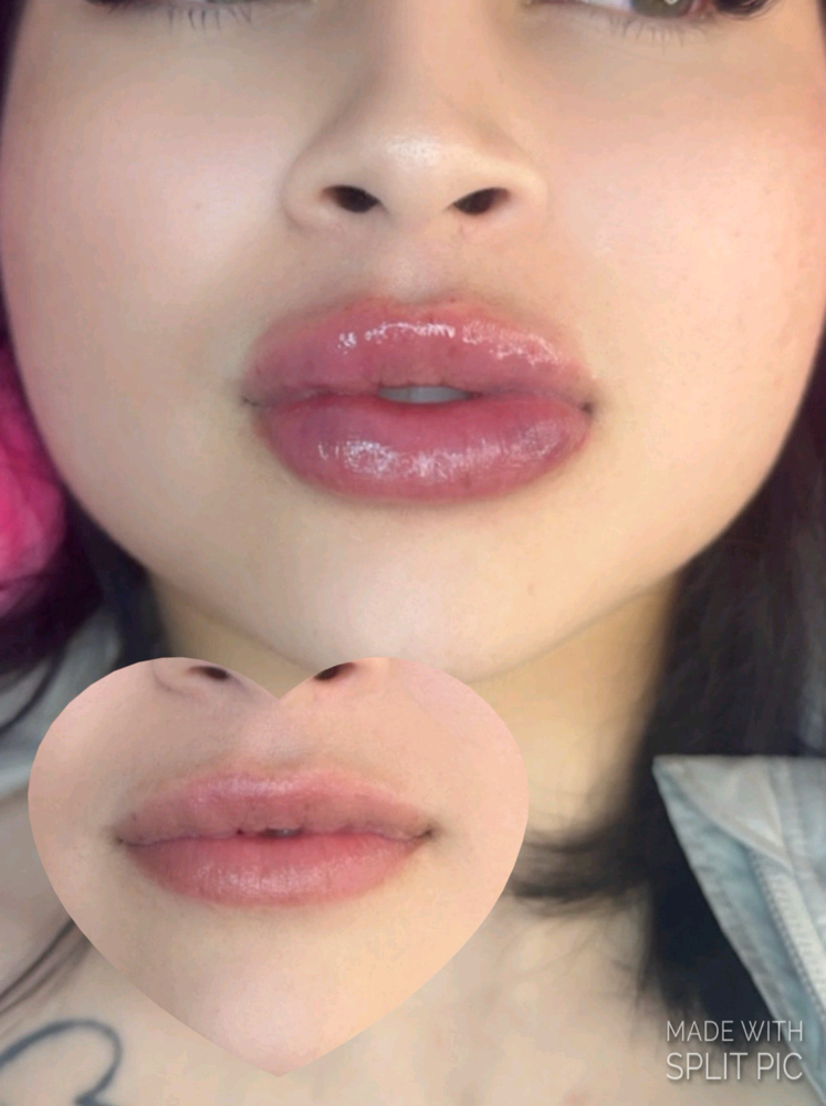 Lip Augmentation 2 Ml