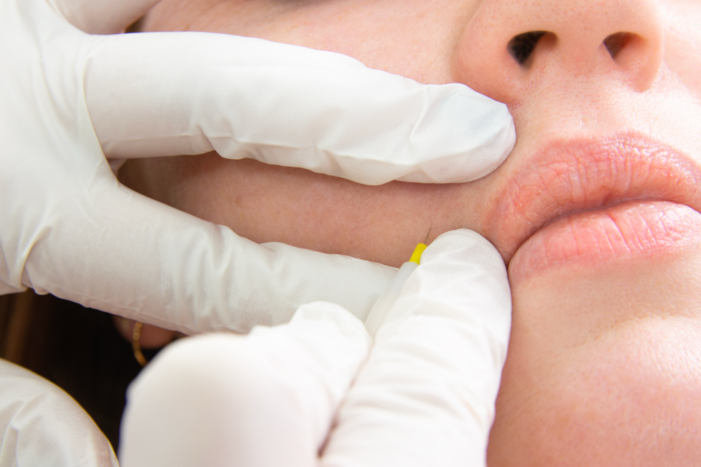 Electrolysis- New Client Consult