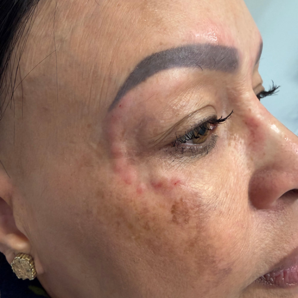 Neurotoxin at Atelier Aesthetics and Infusions in Dallas, TX