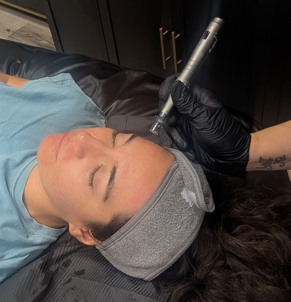 Microneedling