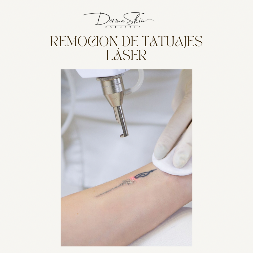 Remoción De Tatuajes