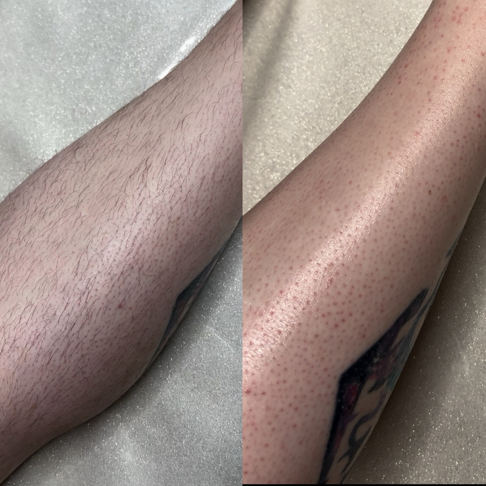 Sugaring Half Leg (upper)