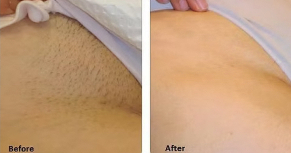 Natural Permanent Hair Removal