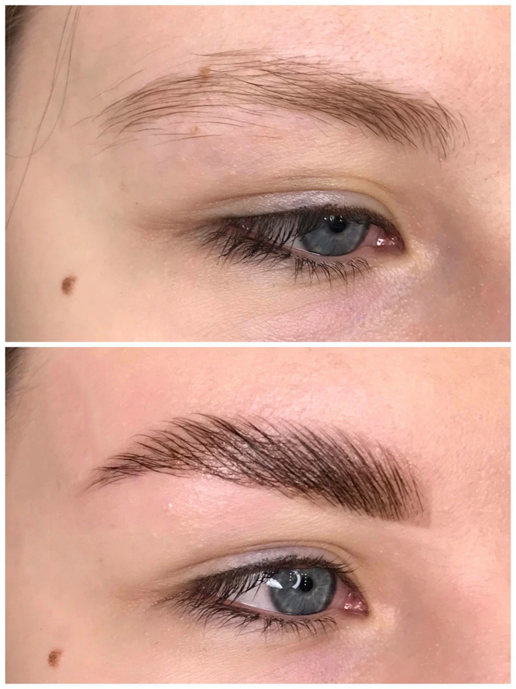 Brow Lift