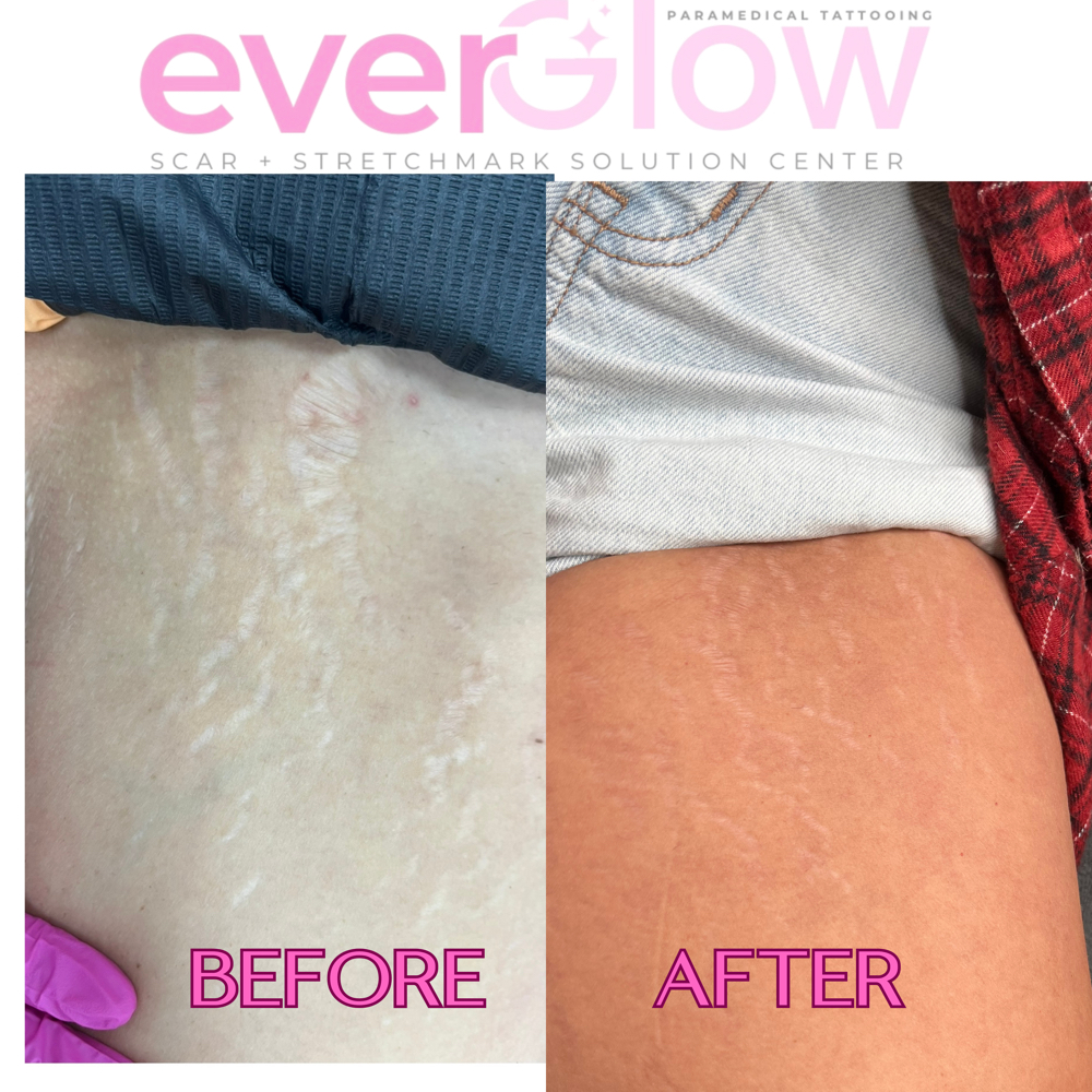 Stretch Repair: Inner thigh at Ever Glow Paramedical Beauty Lounge in Lubbock, TX