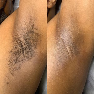Underarms at LET ME GLOW STUDIO in Powder spring, GA