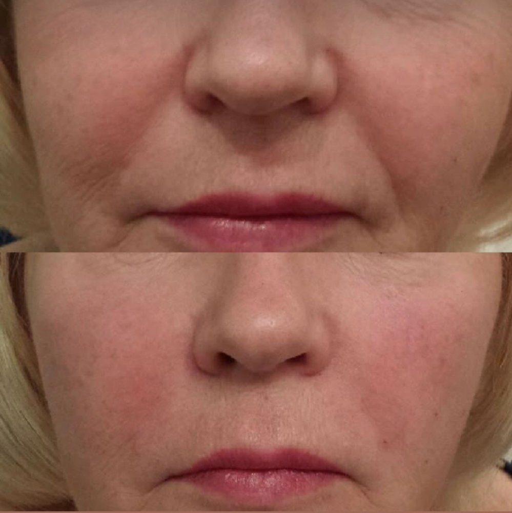 Smile Line Softener (Nasolabial)