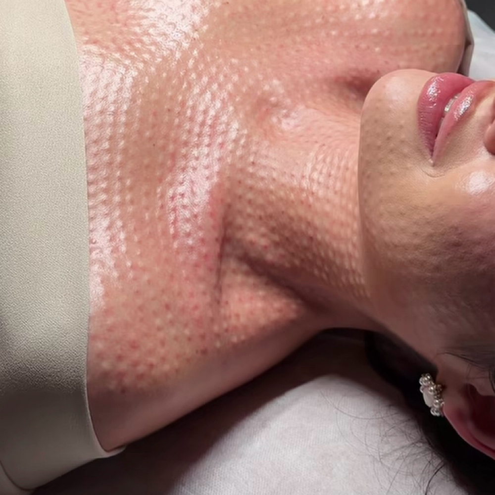 Décolleté & Neck Rejuvenation at Sahar Beauty Professional in Livonia, MI