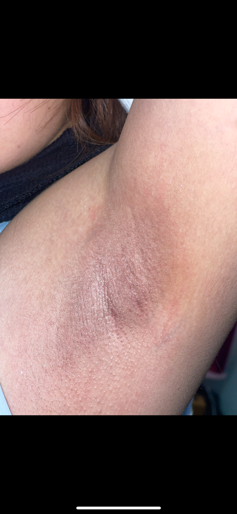underarms