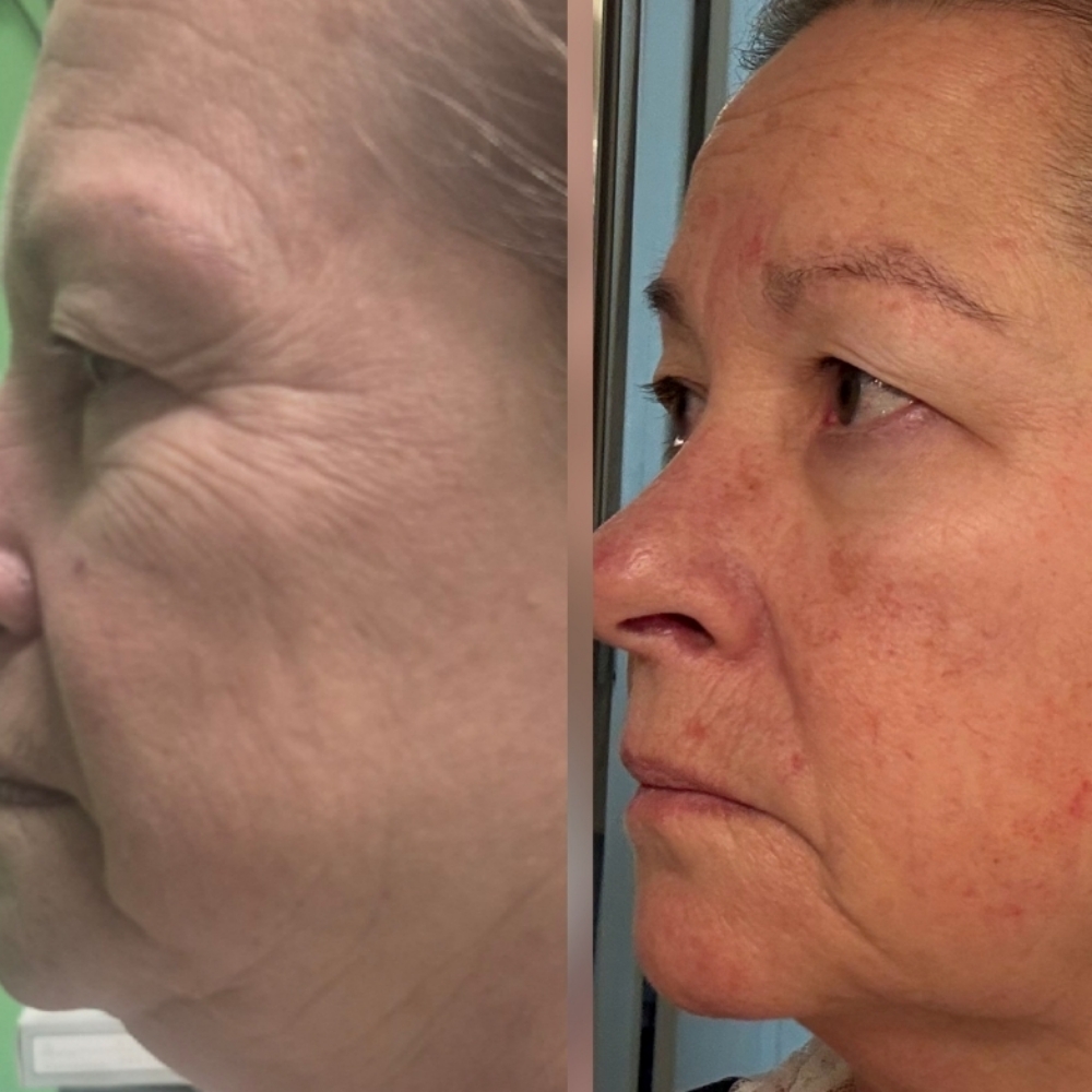 👁️ Eye Lift & Glow Facial at JUST BEAUTIFUL SKIN in Goose Creek, SC